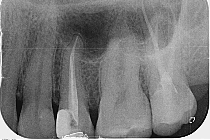 Wurzelbehandlung – Endodontologie